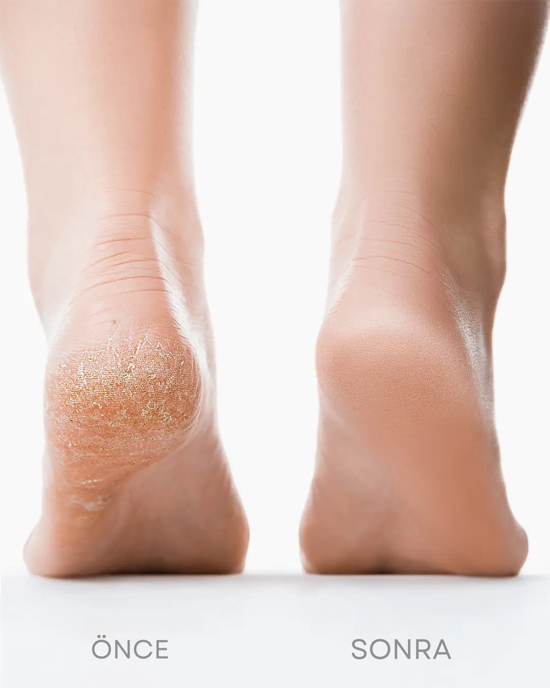 Markenda Silk 3 Pro – Dakikalar İçinde Pürüzsüz Ayaklar | Elektrikli Nasır Giderici